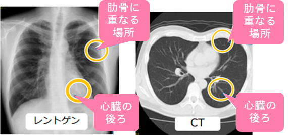 胸部 Ct 検査 で わかる 範囲 | 胸部Ct 正常画像 : 肺CT検査について – UWXOE